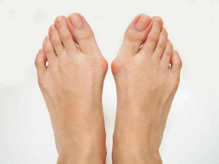 claw toes